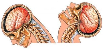 Menenjit Nedir? Menejit Tedavisi