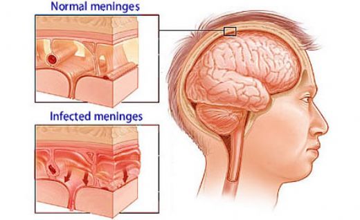 Menenjit